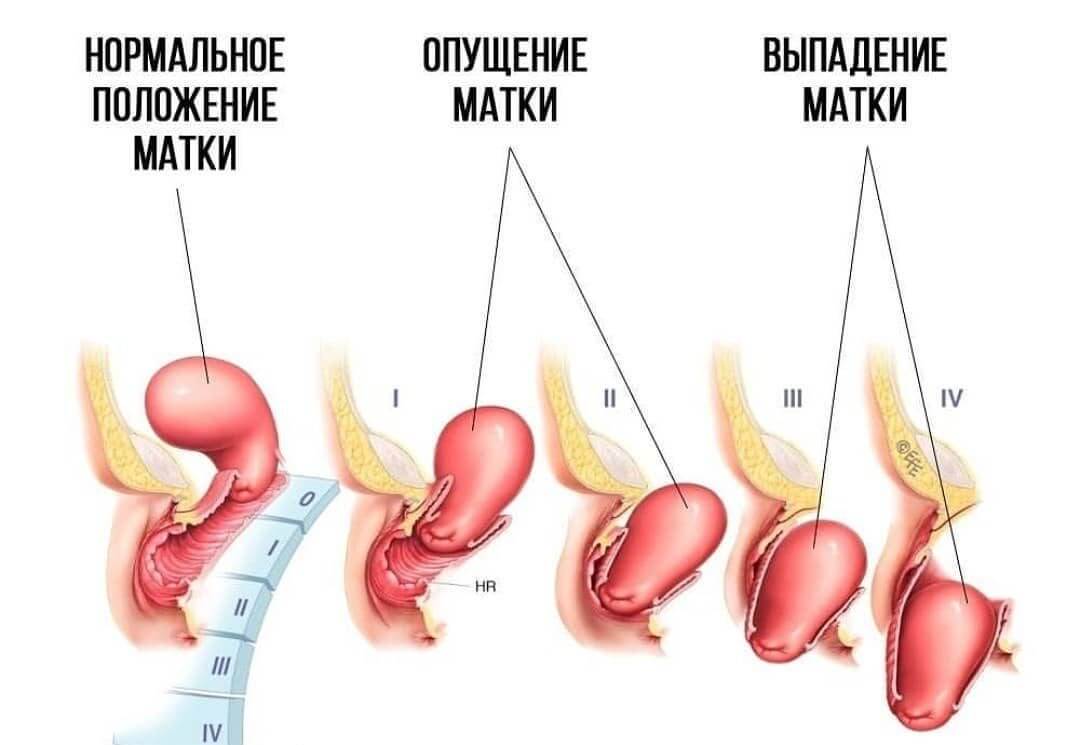 Опущение тазовых органов: симптомы, причины и методы лечения