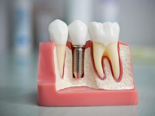 Имплантация, или вживление зубов