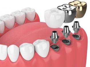 Импланты зубов, как выбрать лучшие
